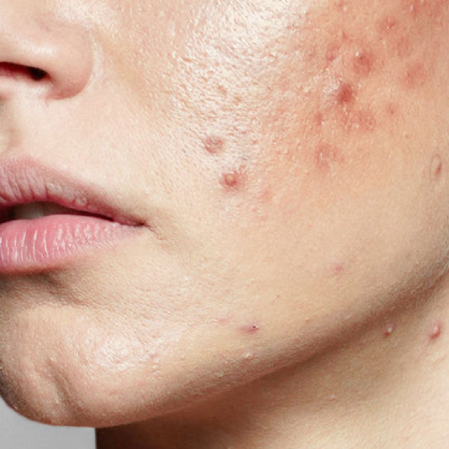Acne