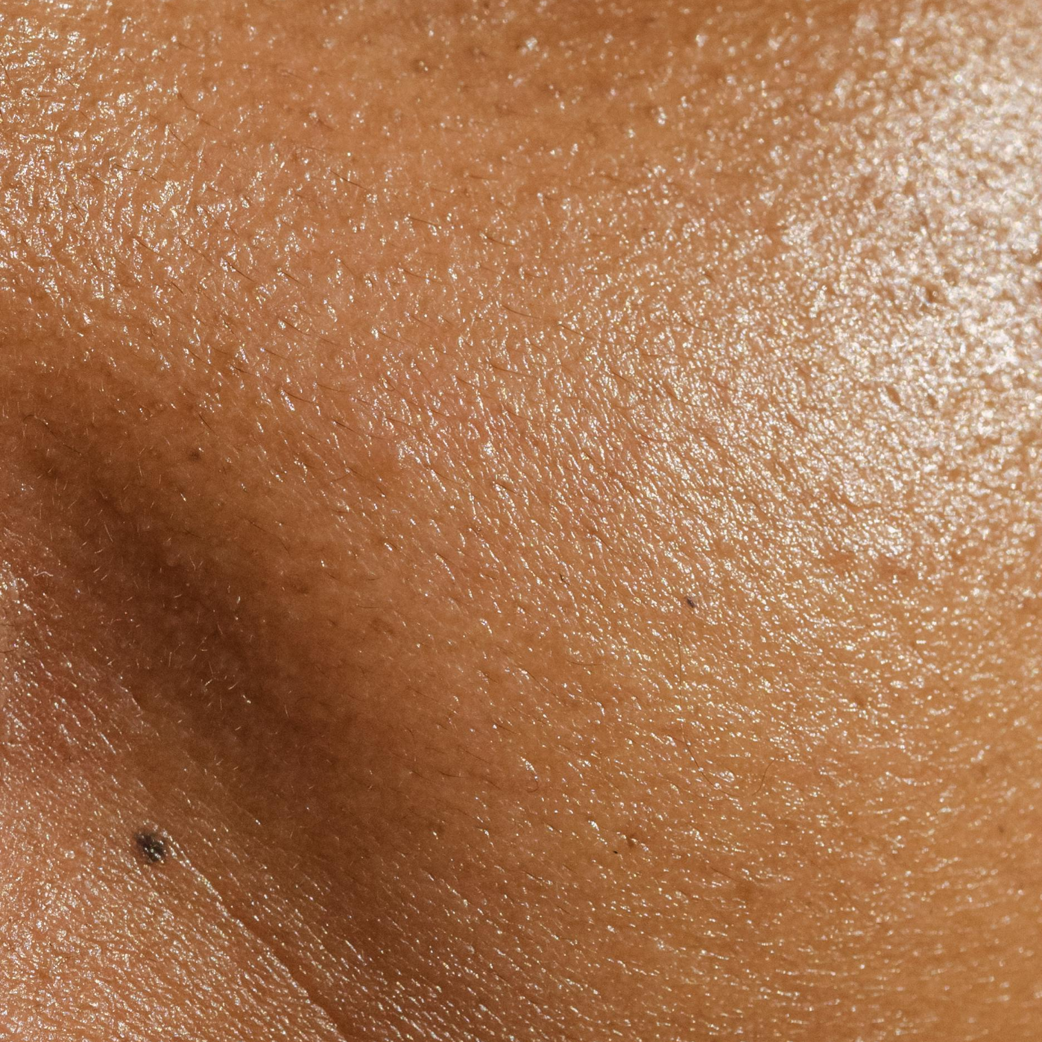 Excess sebum